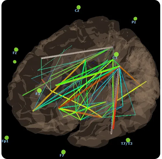 A 3D brain map produced by the BrainMaster system