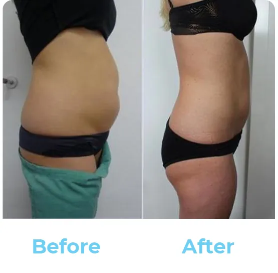 Before and after a course of cryotherapy