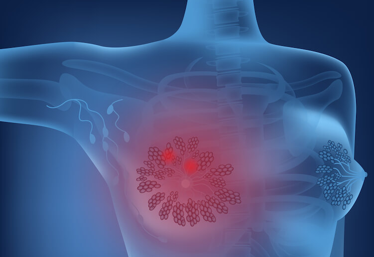 A woman in a consultation about breast health