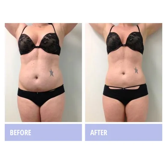Before and after Zerona body contouring